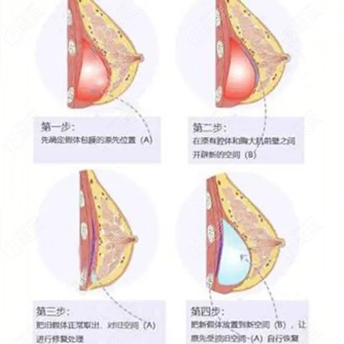 假体丰胸三个月，美丽蜕变的旅程