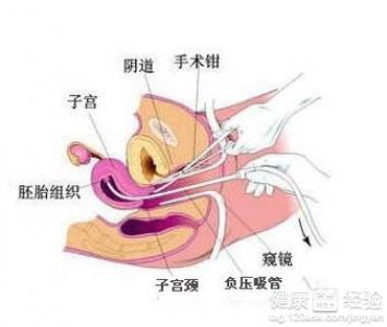 四个月半引产手术，全面解析与注意事项