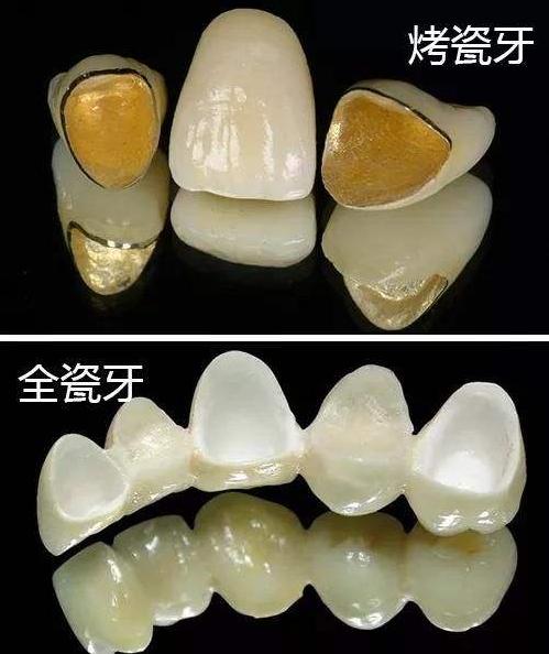 广东省口腔全瓷牙，技术、应用与市场前景